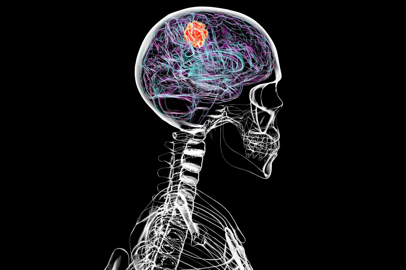 brain_tumor_x-ray_illustration